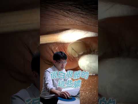 臉上的痘痘大家一定都看過，但大家有看過眼睛的嗎👀 #蕭家杰醫師 #高雄眼科醫師 #屏東眼科醫師 #大學眼科 #麥粒腫 #針眼