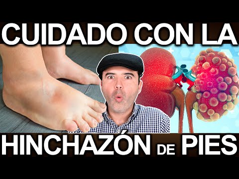 HINCHAZÓN DE PIES - COMO ELIMINAR LA RETENCIÓN DE LÍQUIDO