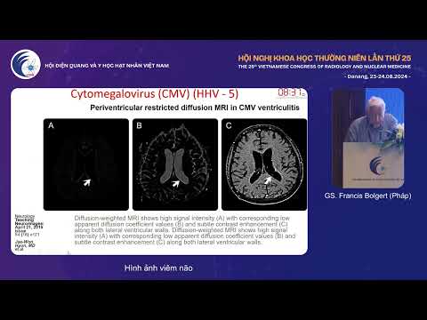 1. Hình ảnh viêm não (GS. Francis Bolgert)