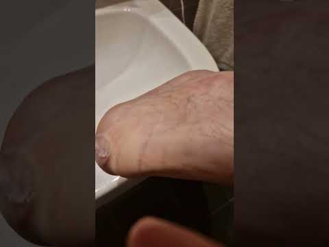 Popping a blister. #shorts #blister #pop