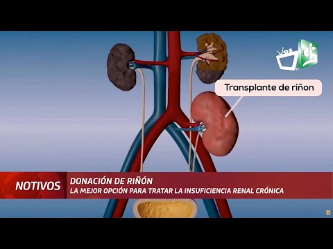 Trasplante de riñón: La salvación de quienes sufren insuficiencia renal crónica