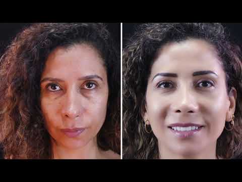 MIRA ESTE CASO...!!! ¿Una blefaroplastía REJUVENECE el rostro?? Dr Percy Nevado Cirugía Plástica