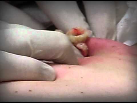 BIGGEST CYST ON THE PLANET | Operation "Kill George"