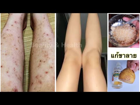 ขาลายทำไงดี-ขาลายแพ้ยุง-น้ำเหล ขาลายทำไงดี-ขาลายแพ้ยุง-น้ำเหล