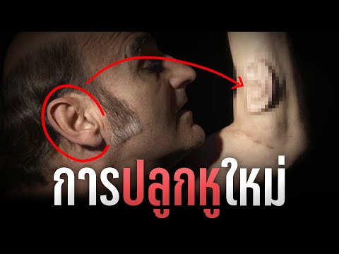 การปลูกหูใหม่ในแขนคุณถ้าหูคุณข