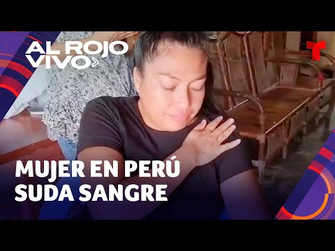 Mujer en Perú padece extraña condición que la hace sudar sangre