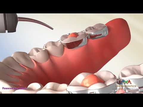 Posterior Bite Block - Orthodontic Treatment