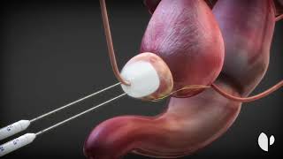 Ventajas de la crioterapia en el cáncer de próstata