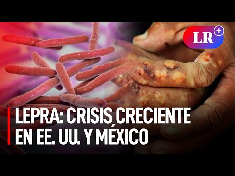 El RESURGIMIENTO de la LEPRA: ¿Una EPIDEMIA INMINENTE en ESTADOS UNIDOS y MÉXICO?