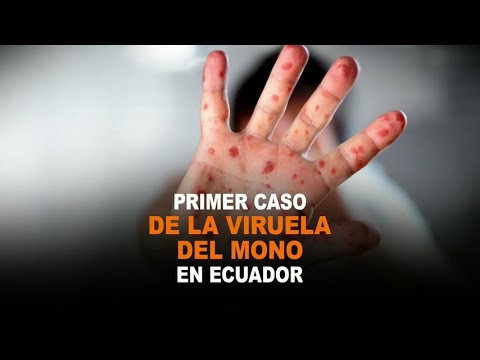 Detectan el primer caso de viruela del mono en Ecuador