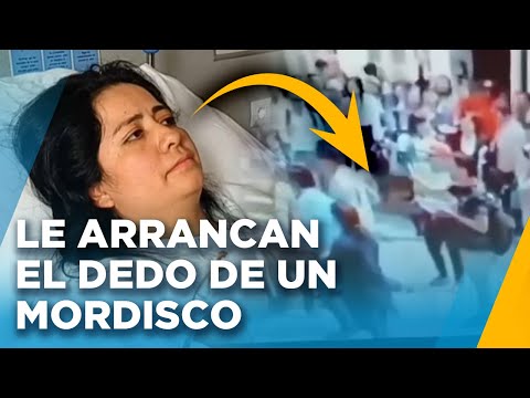 Regidora pierde el dedo por mordisco en San Marcos: La señorita quiere robarme el celular