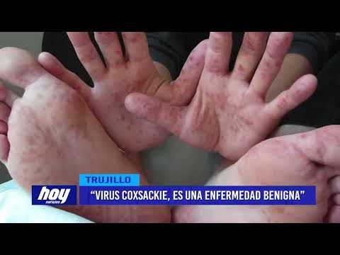 Luis Herrera: “Virus Coxsackie, es una enfermedad benigna”