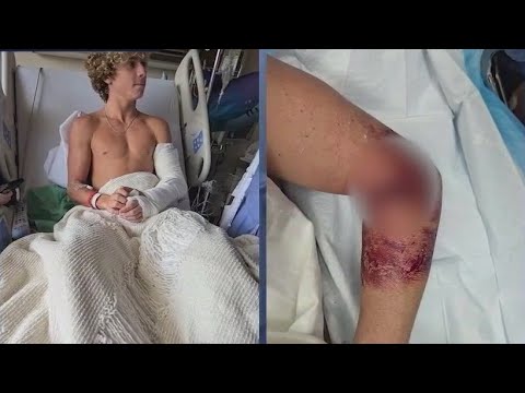 Teen surfer survives shark attack in Florida: 'Could have been so much worse'