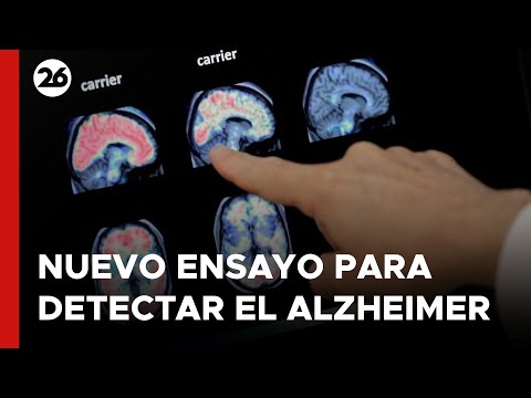 Nuevo ensayo para detectar el Alzheimer en el Reino Unido