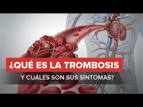 ¿Sabías que las varices te pueden causar trombosis?