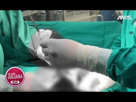 Tarapoto: Médicos salvan a niño que fue atravesado por un arpón