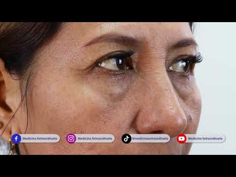 ELIMINA las BOLSAS de los OJOS  Blefaroplastía inferior  PÁRPADOS HICHADOS ? DR PERCY NEVADO