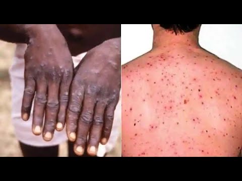 MOH Concerned About Monkeypox