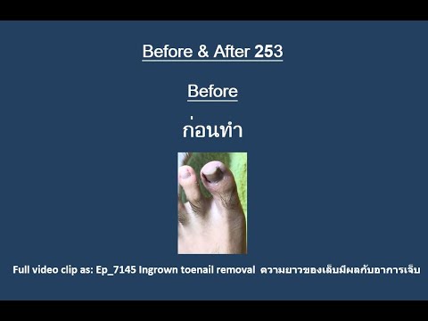 BA_253BeforeandAfter👣มาดู