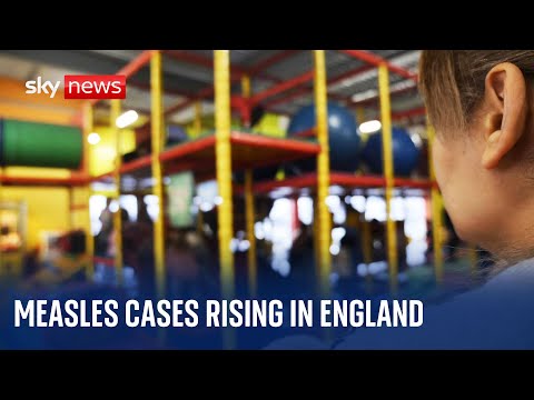 Measles cases surging in England and Wales, lead by the West Midlands