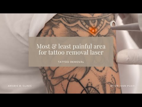 Most & least painful area for tattoo removal laser | Amaris B. Clinic by Dr Ivan Puah