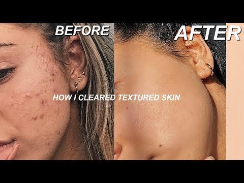 HOW I GOT RID OF TEXTURED SKIN  |  TIPS FOR CLEAR SKIN