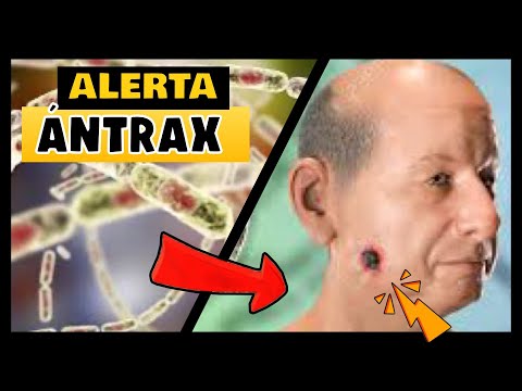 ¡ALERTA! ANTE LOS CASOS REPORTADOS DE ANTRAX EN RUSIA ¿QUÉ ES EL ANTRAX? ¿CÓMO SE CONTAGIA?