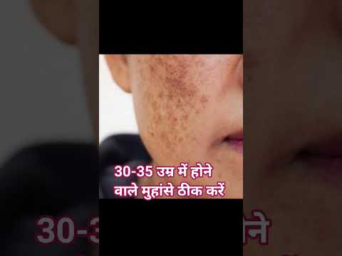 एलोवेरा के एक टुकड़ा लें और अपने गालों पर सुबह शाम घुमाएं ठीक हो जाता है