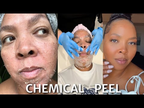 What It's Like To Get A Chemical Peel For Acne Scars | Perfect Derma Peel Procedure