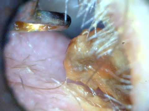 Ear wax removal massive wet plug ASMR