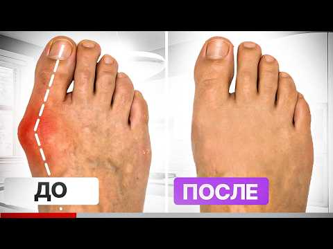 Косточка на ноге растёт из-за ЭТОГО… Упражнения от шишки на стопе