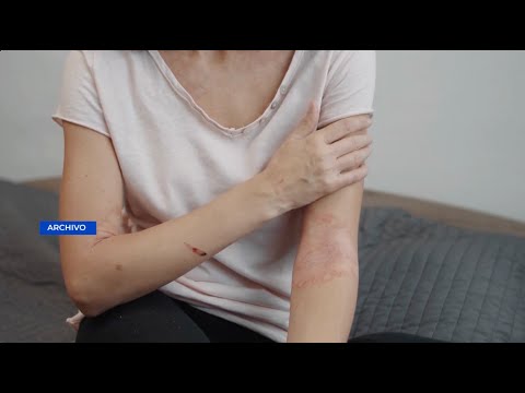 ¿Qué es la Dermatitis Atópica?