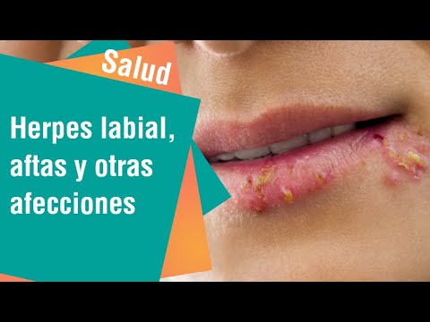 Herpes labial, aftas y otras afecciones frecuentes en la boca | Salud