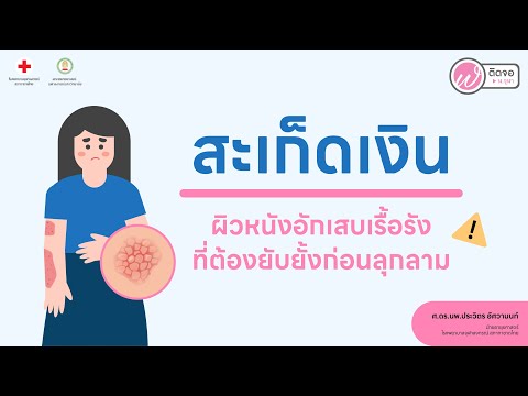 เกร็ดความรู้คู่สุขภาพ|“สะเก็