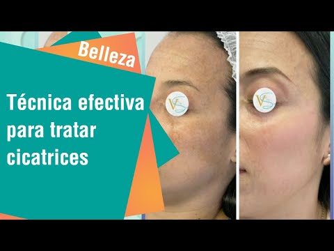 Técnica efectiva para tratar cicatrices y acné | Belleza