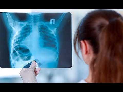Cáncer de pulmón: Conozca los signos más comunes para estar alerta