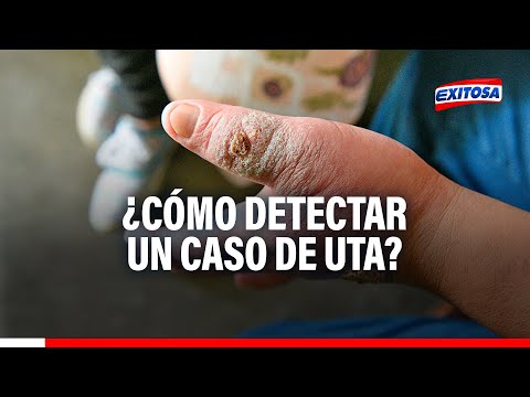 ¿Cómo detectar un caso de uta? Exministro Cevallos explica síntomas de la enfermedad