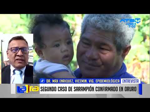 Confirman segundo caso de sarampión en Oruro; Viceministro pide tener precaución