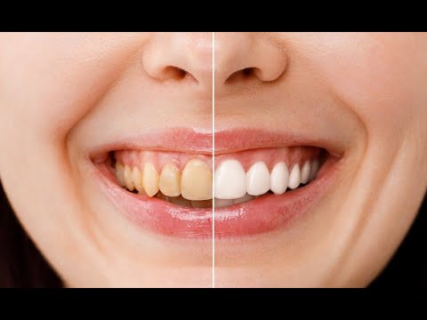 Mitos y verdades del blanqueamiento dental: ¿Es efectivo?
