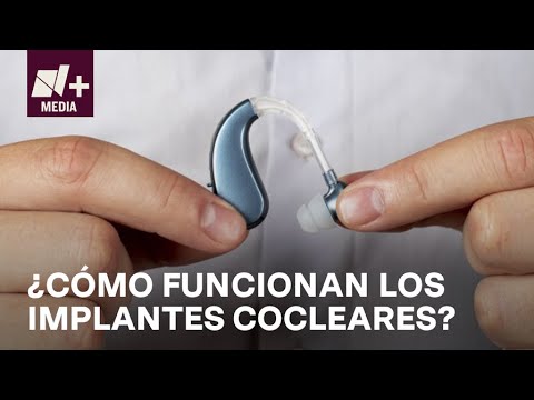 ¿Qué es un implante coclear y cómo funciona? - Bien y de Buenas