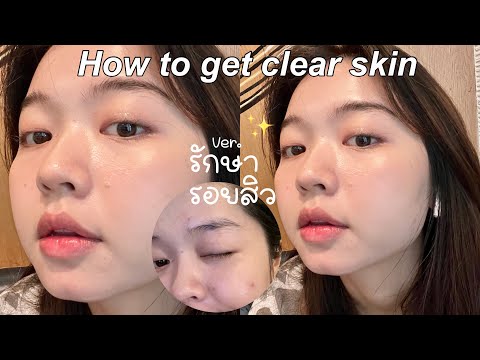 Skincareลดรอยสิวถูกและดีเเห่ง