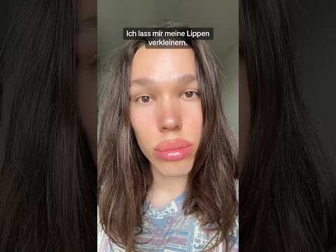 Finally, this burden is off my shoulders. #LipReduction #LargeLips