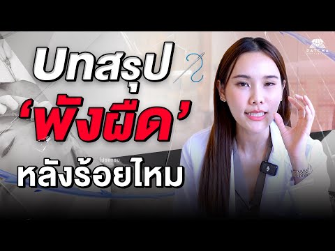 Patcha clinic บทสรุปพังผืดหลังการร้อยไหม