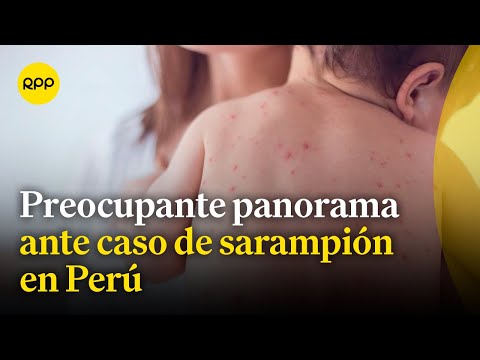 El sarampión llegó a Perú: ¿Podría agravarse la situación?