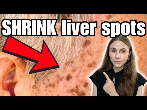 Effective Treatments for Seborrheic Keratosis: Expert Advice