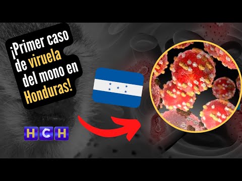 Se confirma el primer caso de viruela de mono en Honduras