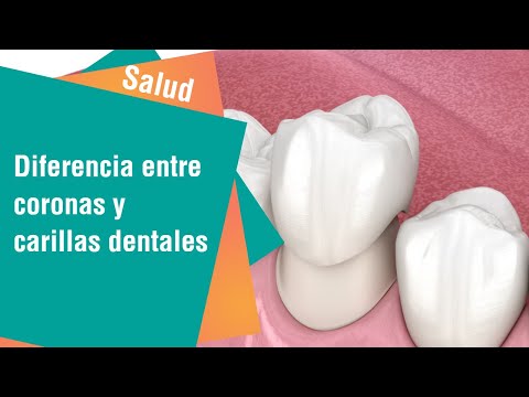 ¿Cuál es la diferencia entre coronas y carillas dentales | Salud
