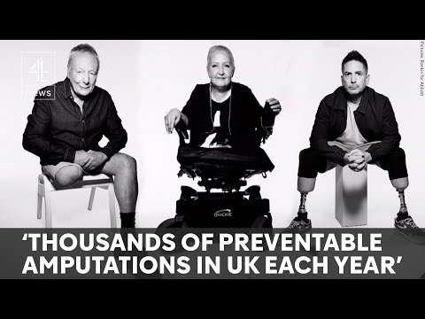 NHS could save millions from preventable amputations - new data