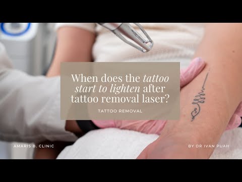 When does the tattoo start to lighten after tattoo removal laser? | Amaris B. Clinic by Dr Ivan Puah