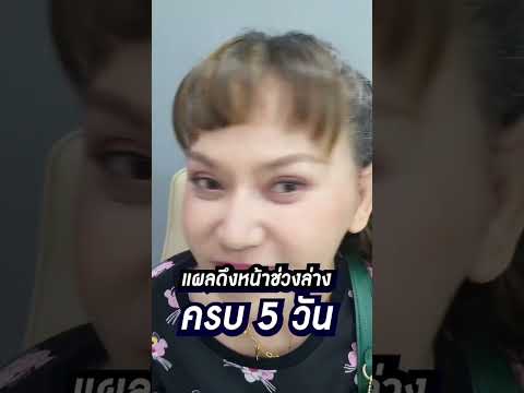 กลับมาดึงหน้า!ในวัยอายุ52ปี